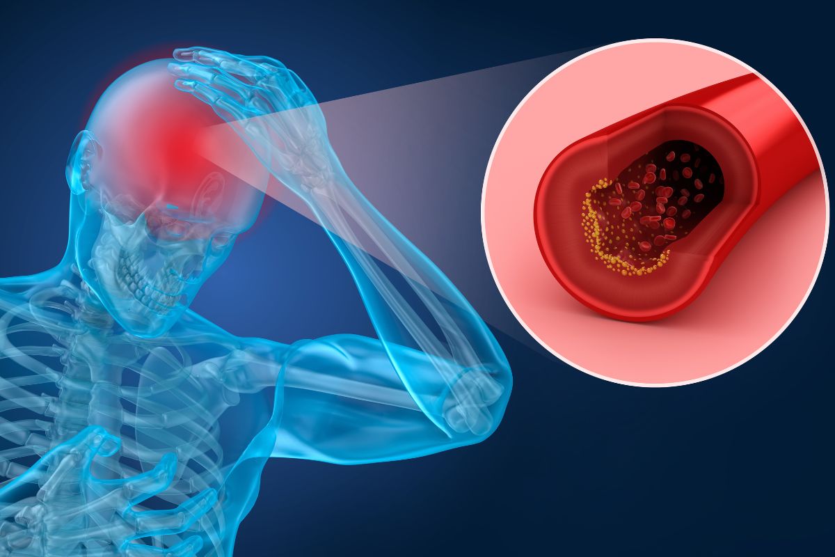 X-ray style person holding head in pain with a close-up inset of a clogged artery and yellow plaque buildup indicating a vascular issue or stroke risk.