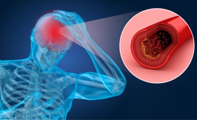 Blue medical illustration of a person holding their head in pain, with a zoomed cross-section of an artery showing plaque buildup.